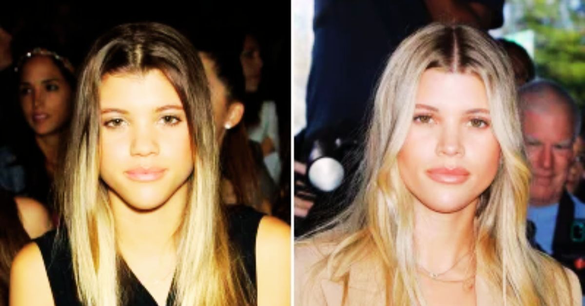 Sofia Richie's Glass Skin Is Thanks to Plastic Surgery!