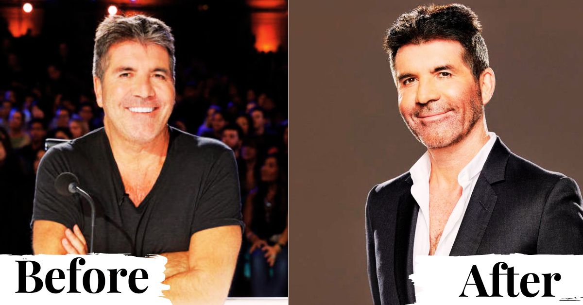 Simon Cowell Plastic Surgery