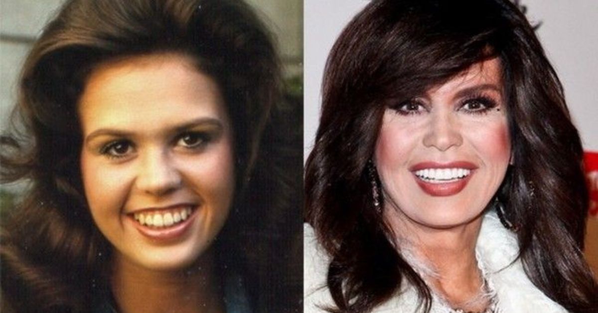 Marie Osmond Plastic Surgery